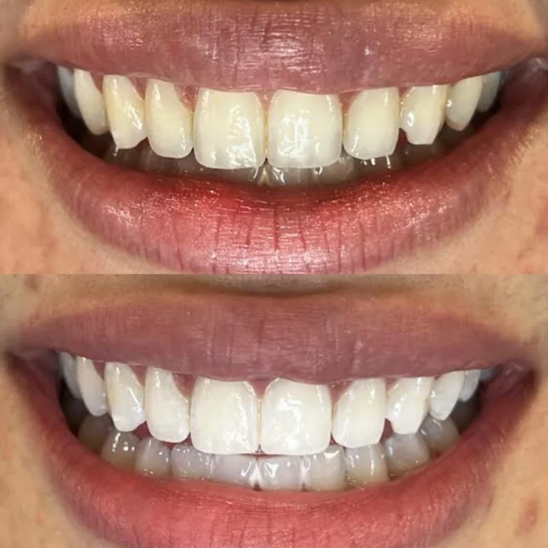 Cosmetic Teeth Whitening: How to Get a Brighter Smile Safely